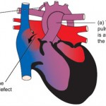 img-the-norwood-procedure