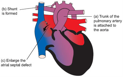 The Norwood Procedure was pioneered in Philadelphia. The procedure, a stop gap protocol, is performed within a few days of birth and involves improving circulation of oxygenated blood to the body. 