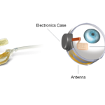 Argus II retinal implant