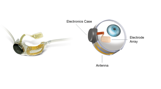 Argus II retinal implant