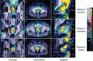 hNIS adenovirus prostate treatment as viewed by radiologists