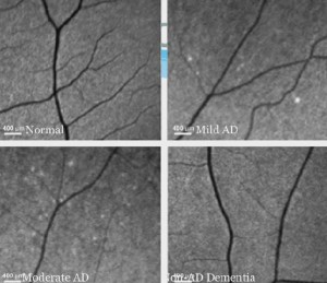 Retina-test-for-Alzheimers