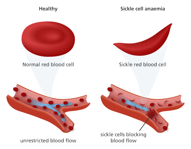 Can Genetic Engineering Cure Sickle Cell Anemia?