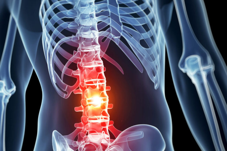 Can Nanoparticle Injections Prevent Spinal Cord Injury Paralysis?