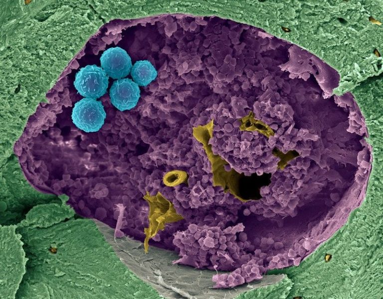 Blood Stem Cell Transplants May Be the Way We Treat Blood Disorders and Autoimmune Diseases in the Future