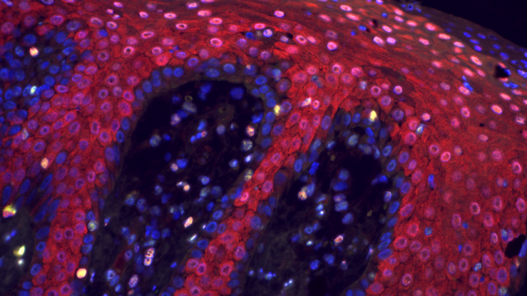 Could Defective Stem Cells Be The Cause of Psoriasis?