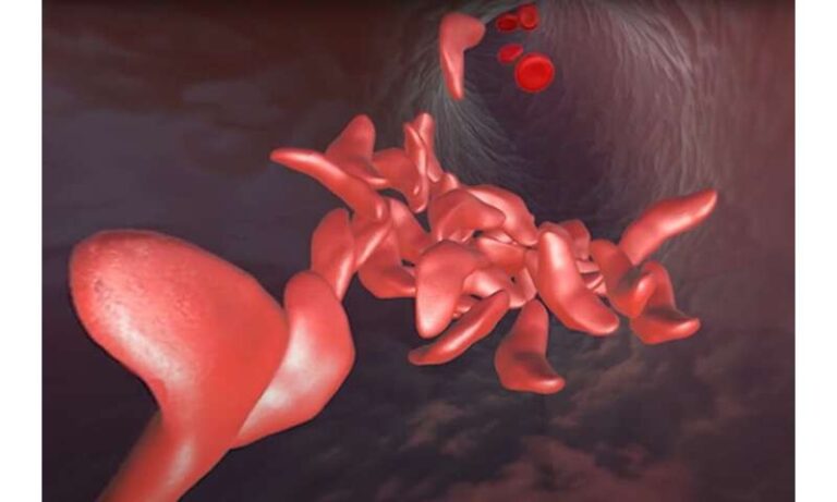 CRISPR Tackles Sickle Cell Disease