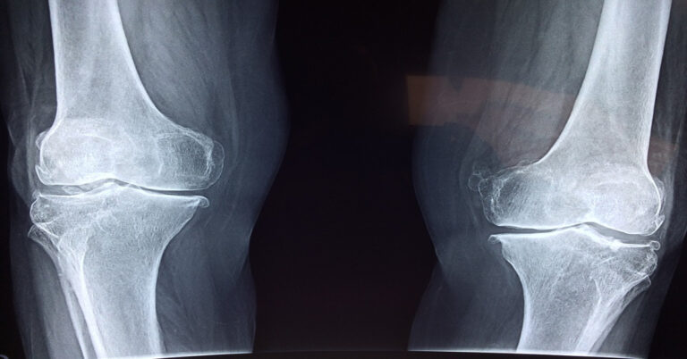 Are We Closer to Non-Surgical Repairs for Osteoarthritic Knees?