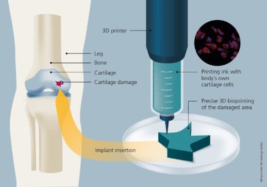 I Had Knee Replacement Surgery in 2020 But Could 3D Bioprinting Do The Job In The Future?